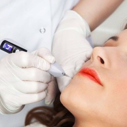 Pluma de Plasma Láser para Eliminar Liunares y Pecas 17120-57